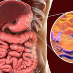 Un estudio argentino reveló datos sobre una bacteria que causa desde gastritis hasta cáncer