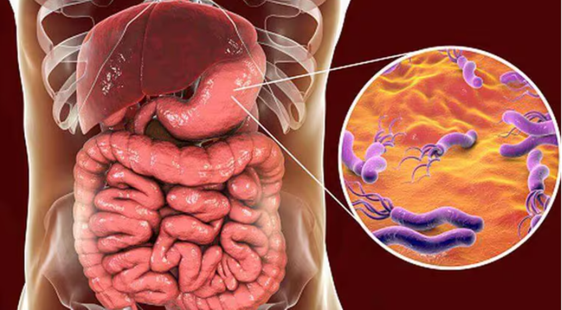 Un estudio argentino reveló datos sobre una bacteria que causa desde gastritis hasta cáncer