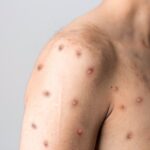 Entre Ríos se mantiene alerta a la situación epidemiológica de la Viruela del Mono