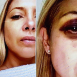 Tras la denuncia a Alberto Fernández, se conocieron las fotos de Fabiola Yañez golpeada