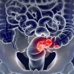 Un nuevo tratamiento desarrollado en Israel eliminó el cáncer rectal en el 65 por ciento de los pacientes