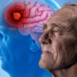 En un avance mundial, investigadores israelíes utilizaron con éxito un tratamiento contra el cáncer de sangre para combatir el Alzheimer